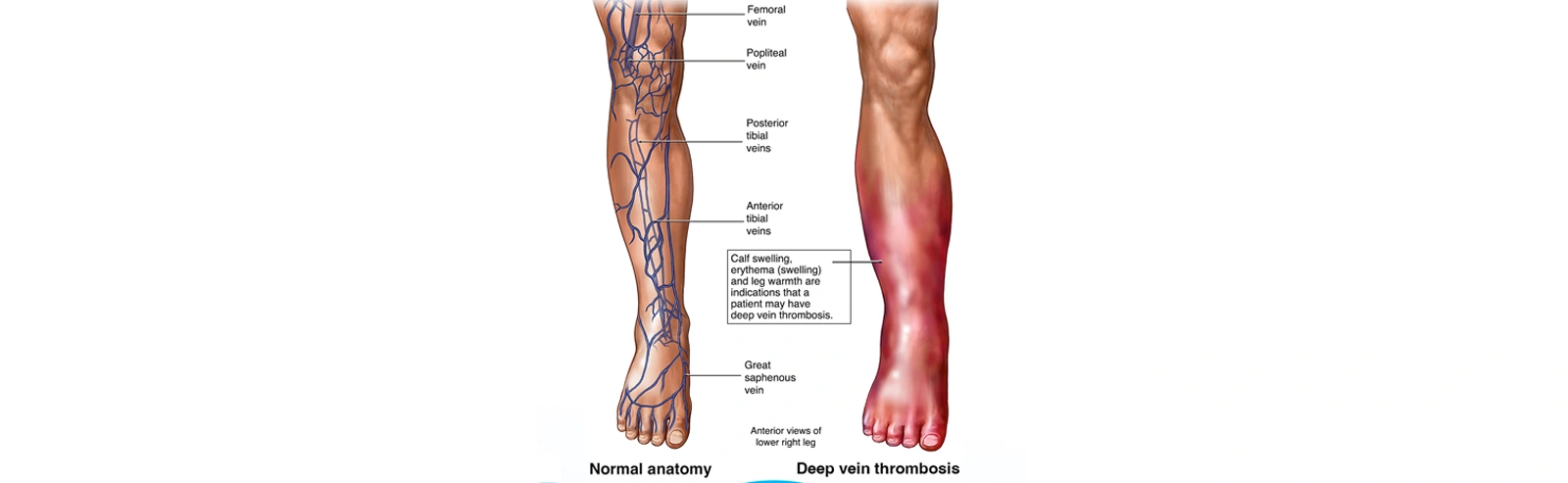 deep_vein_thrombosis_content_images