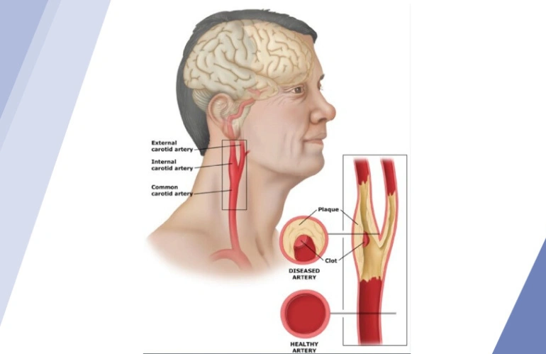 stroke_prevention_content_image