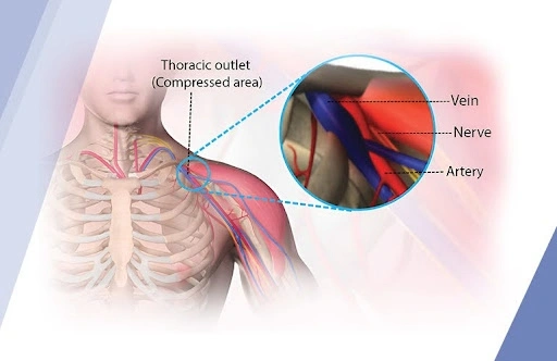 thoracic_outlet_syndrome