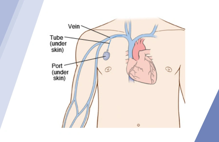 vascular_acess_for_chemotherapy