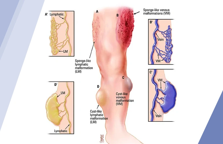 vascular_malformation_content_image_one_stop_vascular_solutions