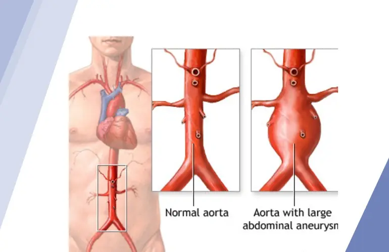 Aortic Aneurysms