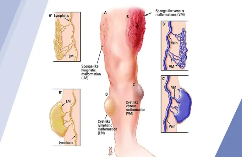 Vascular Malformations