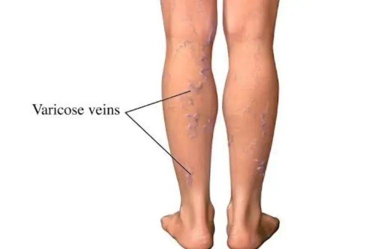 Varicose Veins