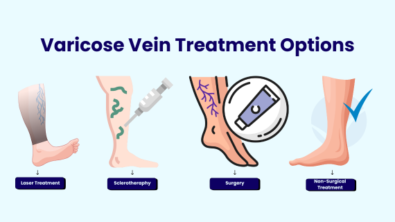 Varicose Vein Treatment Options
