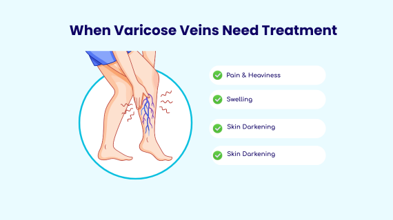 When Varicose Veins Need Treatment